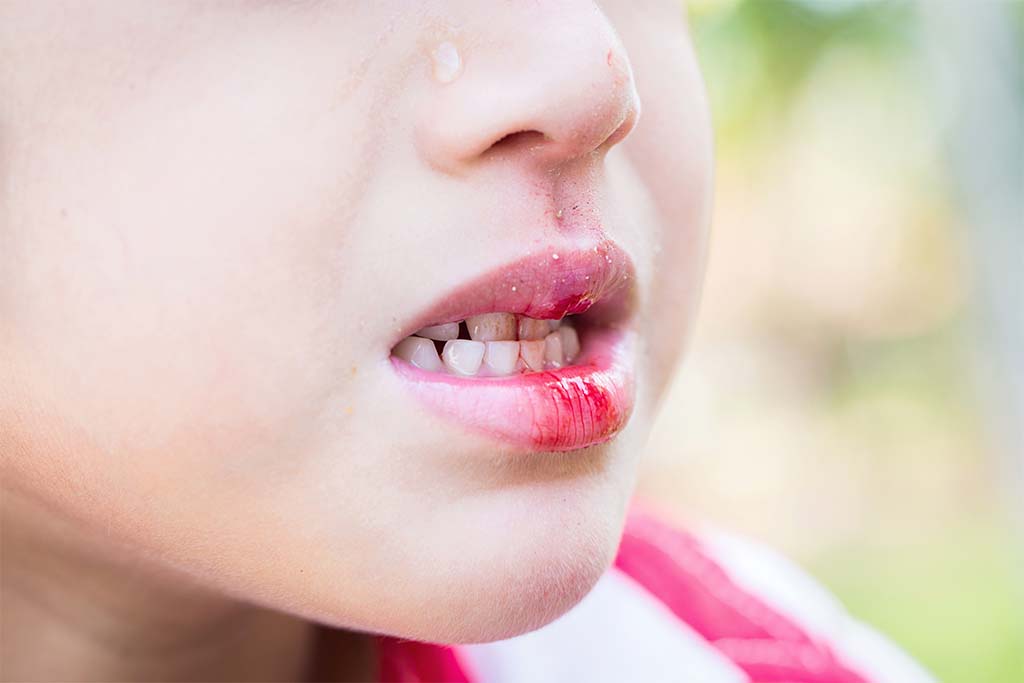 お口の中や口周辺をケガしたり、出血したりしたときは